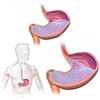 Acid Reflux Heartburn Cure App icon