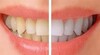 Teeth whitening ‎- ‏تبييض الأسنان icon