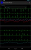 Bedside ECG Monitor screenshot 7