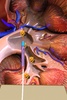 Kidney Laser Surgery screenshot 1
