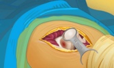 Hip Surgery screenshot 4