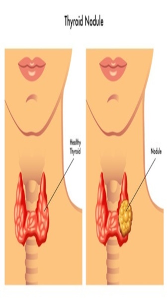 Living With Thyroid Dysfunction: Complete Guide - Preview 3