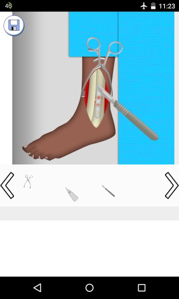Ankle Surgery - Preview 3