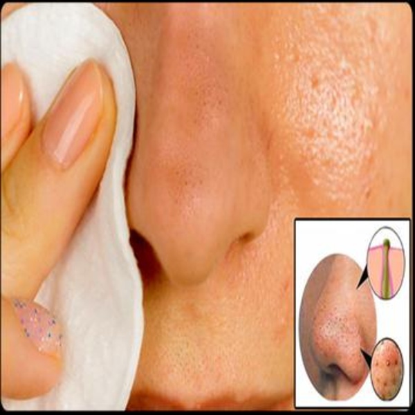 Blackheads Removal - Preview 2