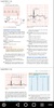 ECG / EKG Rhythm Step-by-Step Interpretation screenshot 4