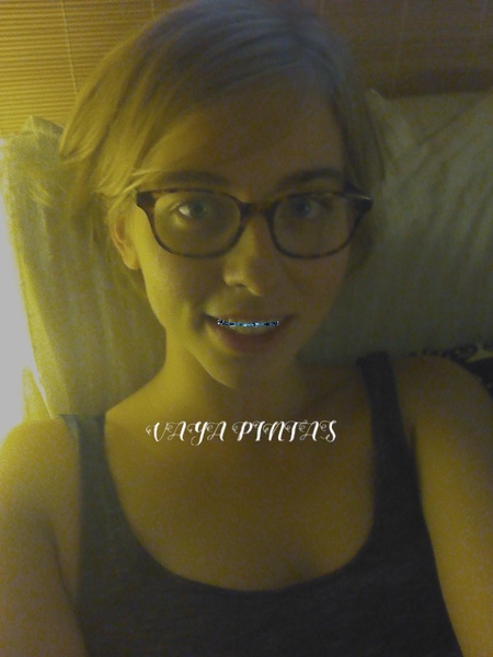 Braces - Preview 4