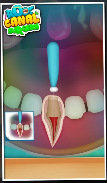 Root Canal Surgery - Preview 3