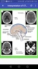 CT Brain Basic Interpretation screenshot 5